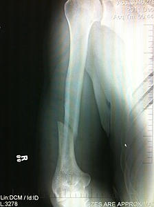 ***Official WA Chat Thread***-broken_arm.jpg